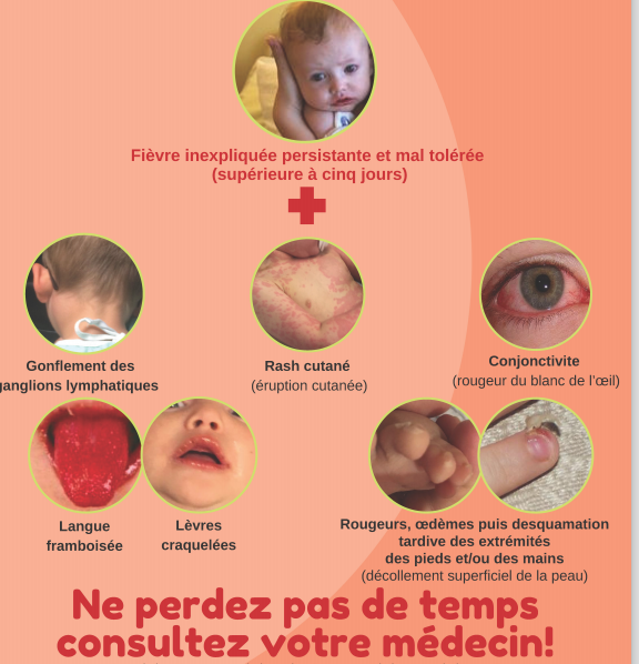 maladie de kawasaki