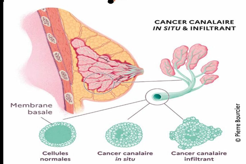maladies cancéreuses