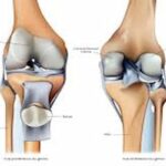 L'usure du cartilage du genou