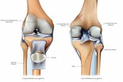 L'usure du cartilage du genou